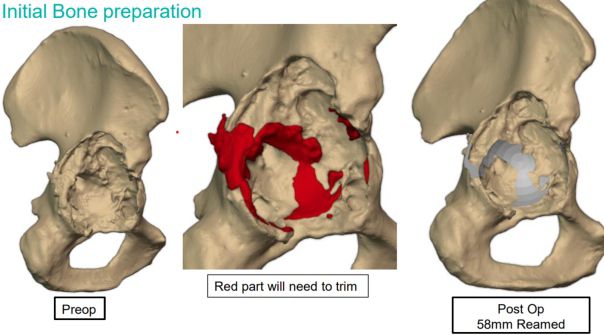 Fig 2 — segmented defect with the bone to be trimmed and the planned 58 mm ream