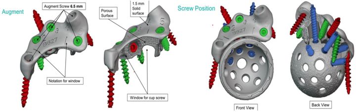 Fig 4 — augment detail with porous surface and windows for cup screws