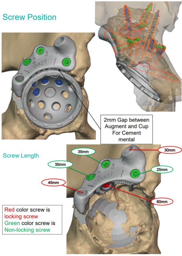Screw position and length plan; locking and non-locking screws colour-coded