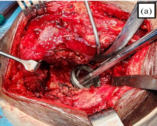 Fig 5a — acetabular defect after cup impaction, matching the plan