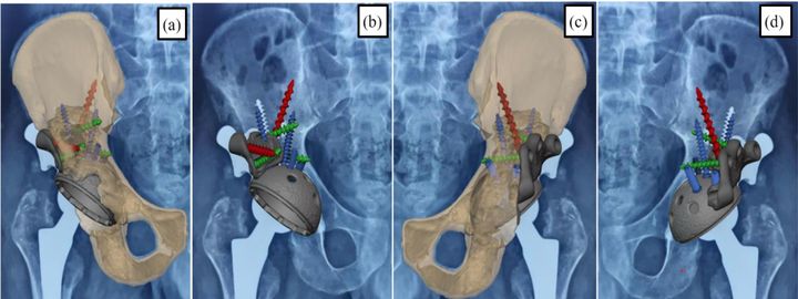 Fig 6 — plan superimposed on post-operative radiographs, anterior and posterior