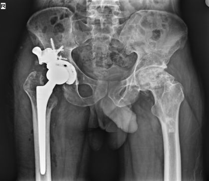 Fig 7 — one-year follow-up radiograph with no signs of loosening