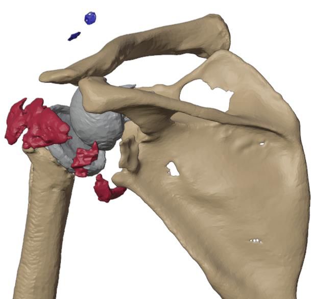 Anterior view — screw fragments and loose bone in red