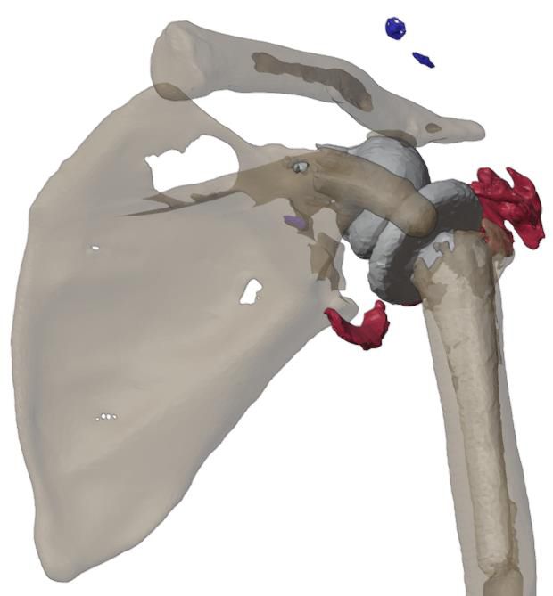 Posterior view of the deformed glenoid