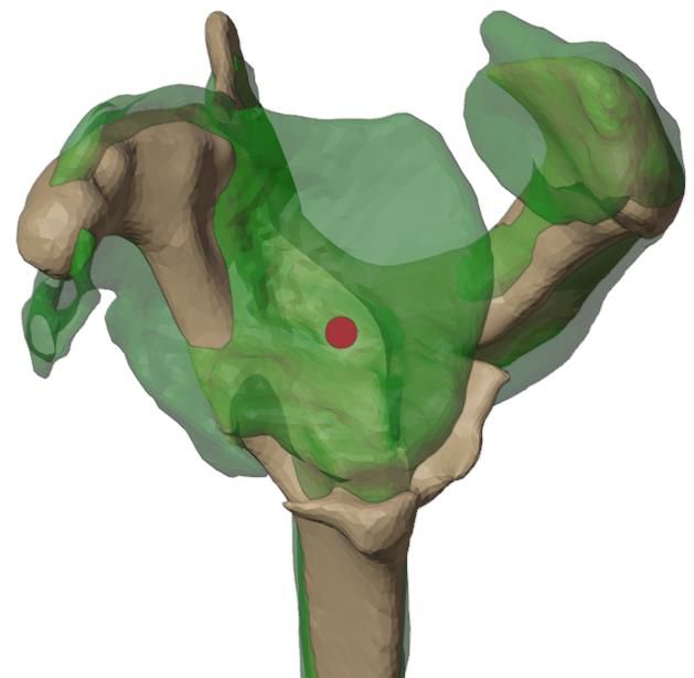 Mirrored healthy scapula matched to the deformed scapula
