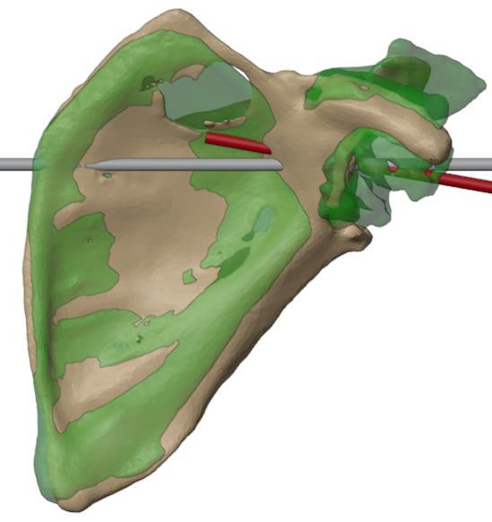 Scapular axis and glenoid centre established