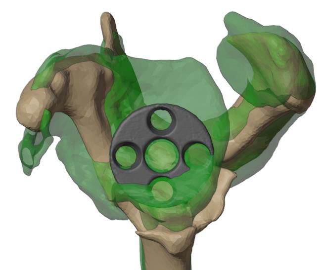 Glenoid centre with a 25 mm diameter mini base plate reference