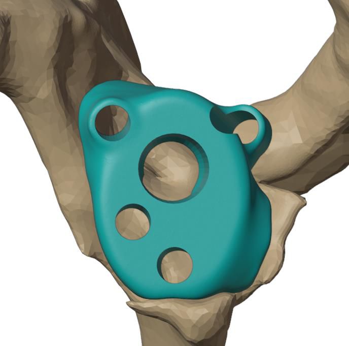 Mini plate seated on the glenoid