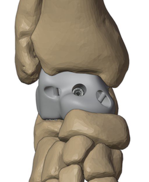 Implant with suture holes and porous surface