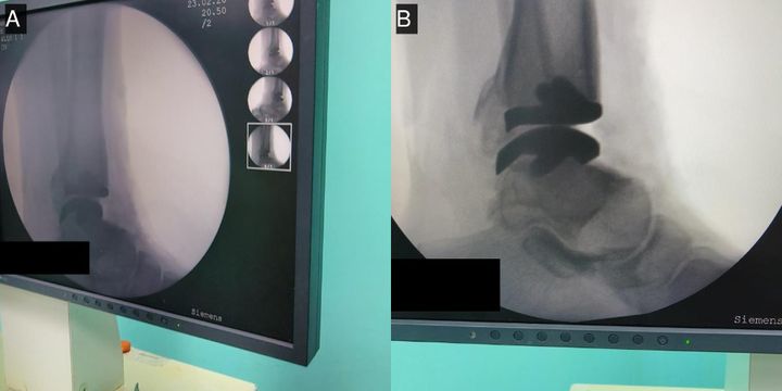 Intra-operative fluoroscopy — guide on the distal tibia and final component position