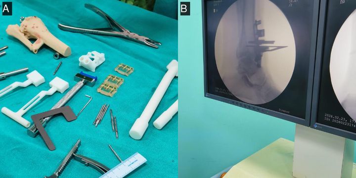Back-table array of patient-specific guides and instruments; anterior approach