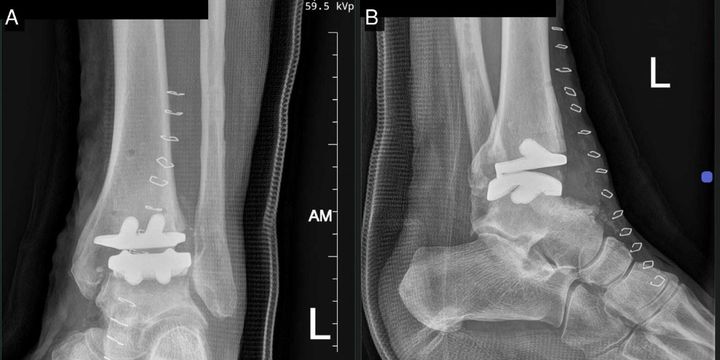 Immediate post-operative radiographs — AP and lateral