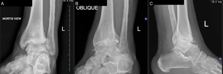 Pre-operative weight-bearing radiographs — AP mortise, oblique and lateral