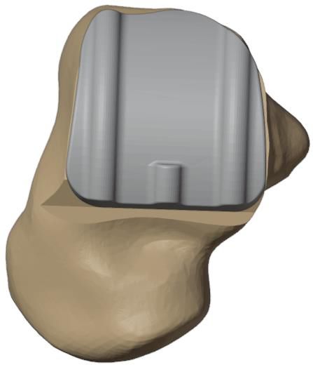 Step 9 — talar implant impacted
