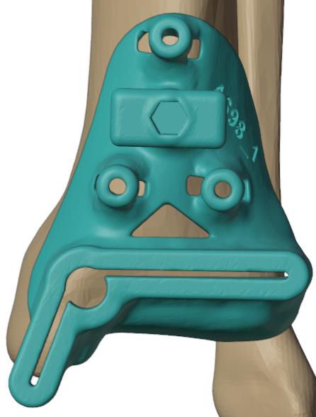Step 1 — PSI tibial guide seated and pinned