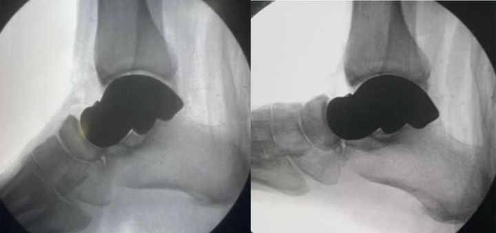 Intra-operative fluoroscopy in plantar and dorsiflexion