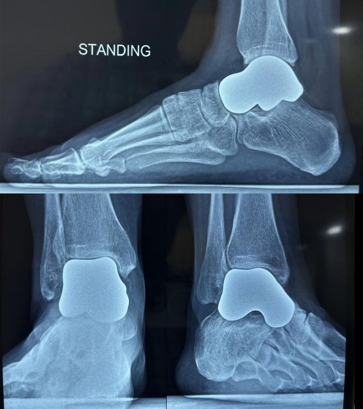 Standing weight-bearing radiographs at follow-up