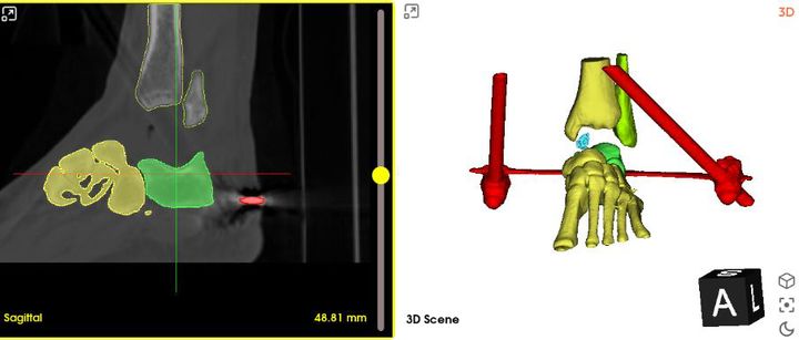 Segmentation and mirroring of the contralateral talus