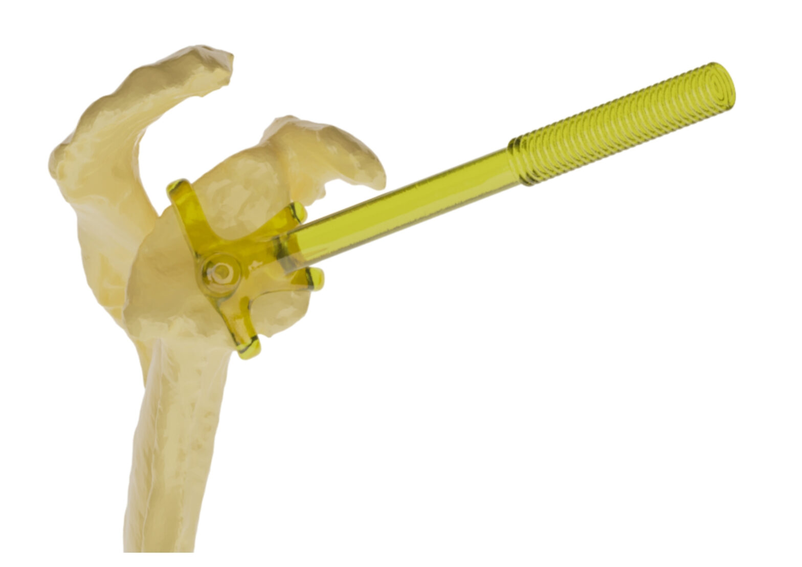 GleniGuide Glenoid Axis Guide