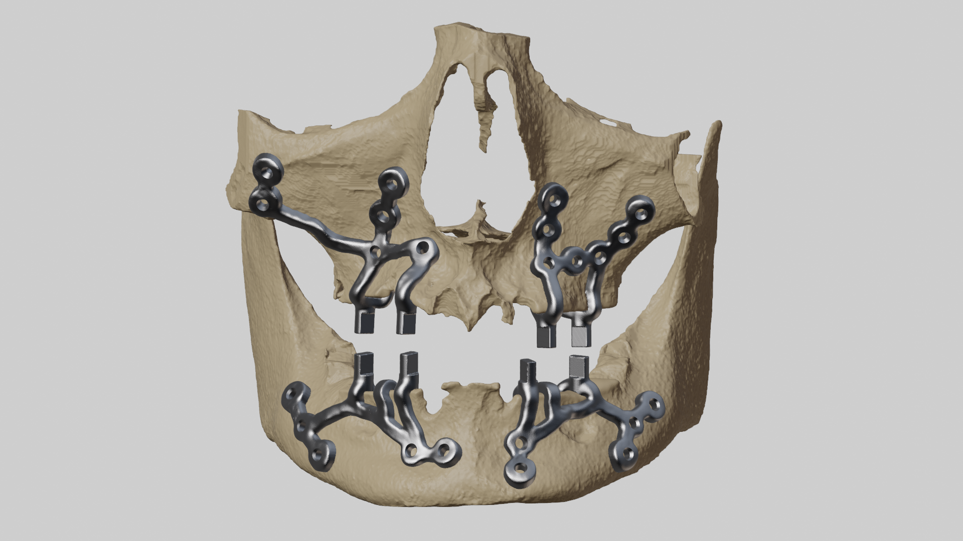 Customised Subperiosteal implant for Maxilla & Mandible - Jajal Medical