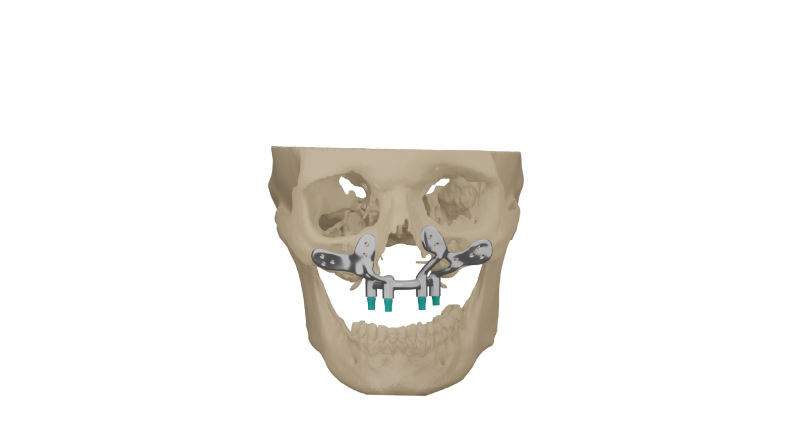 Patient-specific maxilla implant by Jajal Medical