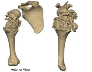  Humerus bone