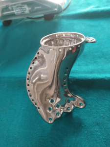 Reconstruction of Right Hemipelvis with a Customized Implant Solution 