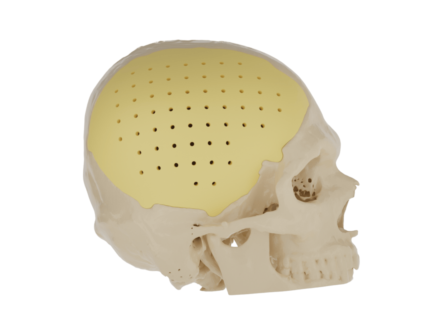 PEKK Implant