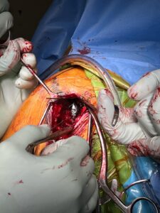  Hill Sachs Lesion post op