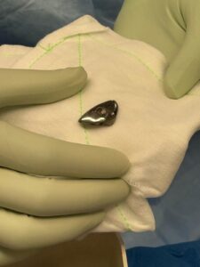 Implant for Hill Sachs Lesion