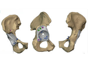 Complex Revision Hip Replacement