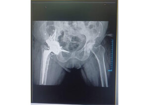 post op for custom FTL Cup surgery