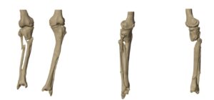 custom tibia implant