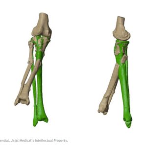 Custom Tibia Implant planning