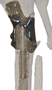 Post op of Tibia Implant 