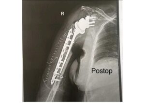post op for reglen implant surgery 