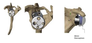 Reglan implant design