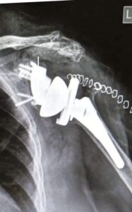 post op of ReGlen - Patient Specific Glenoid Implant