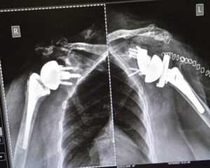 ReGlen - Patient Specific Glenoid Implant