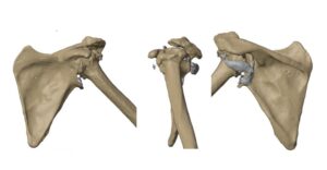 Reverse Shoulder Arthroplasty preop