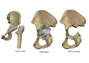 Severe Acetabular Bone Loss with Column Deficiency