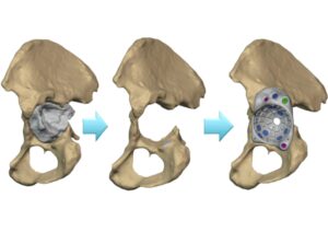 Personalized FTL cup design