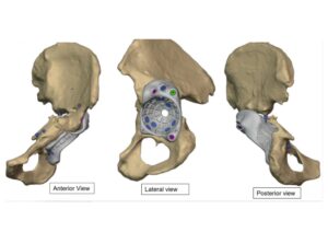 Multi-Flange Fixation for Pelvic Stability