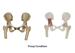 Patient Overview: Pelvic Tumor Case