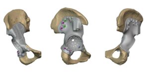 Patient-specific FTL Cup Design for Acetabular Reconstruction 